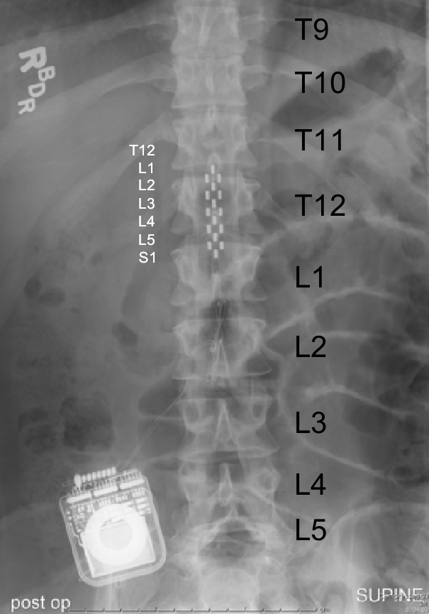 xray spine
